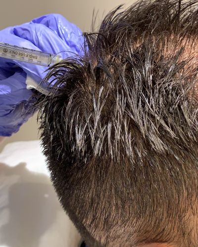 Comment préparer le cuir chevelu pour une greffe de cheveux ?