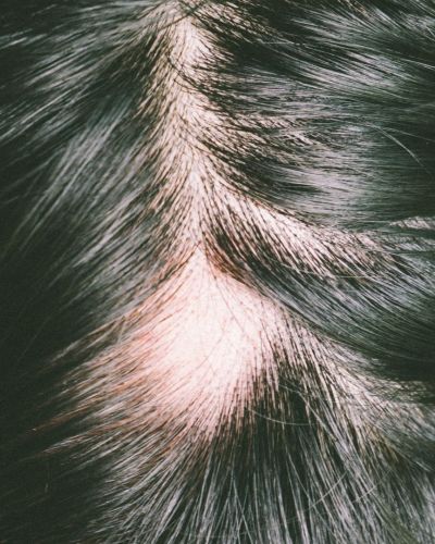 La cause des trous dans les cheveux chez les hommes et chez les femmes : Quelles sont les solutions ?