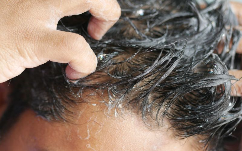 Comprendre la greffe de cheveux 5000 : Explications détaillées et tarifications en Turquie