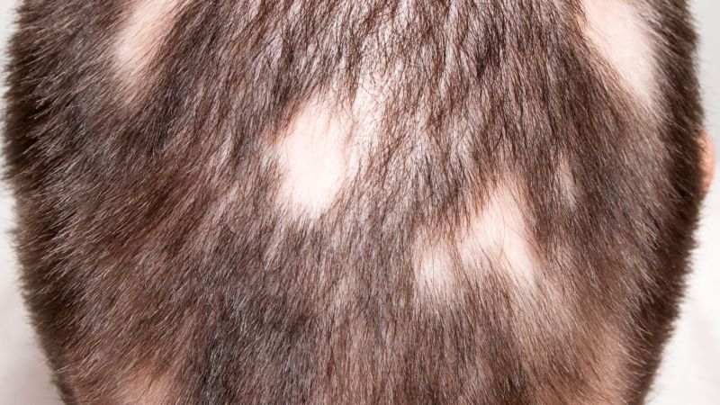 La cause des trous dans les cheveux chez les hommes et chez les femmes : Quelles sont les solutions ?