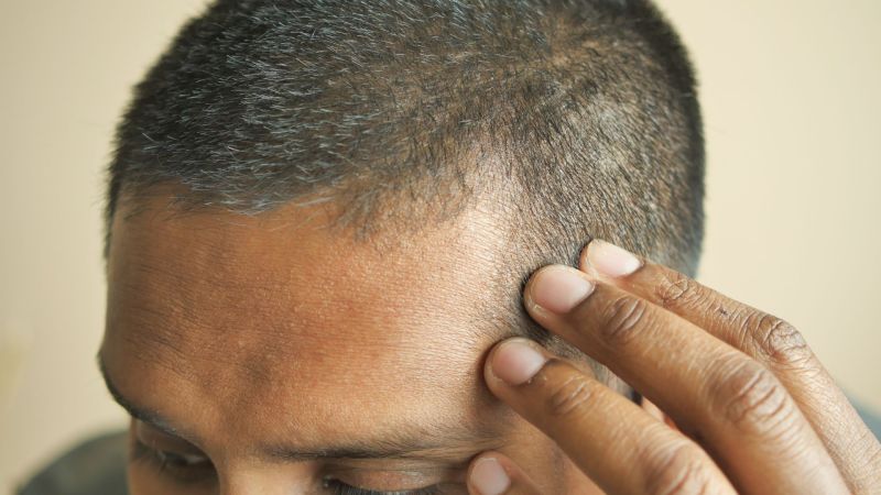Greffe de cheveux aux golfes : prix et diagnostic