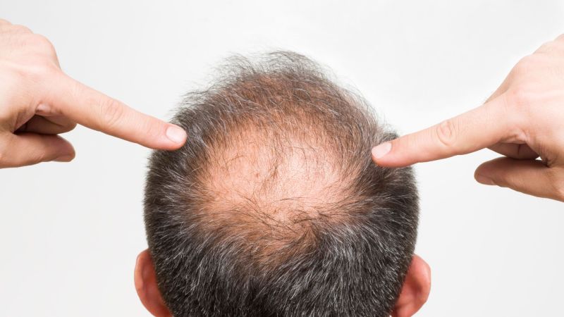 Causes, traitements et origine de la chute de cheveux