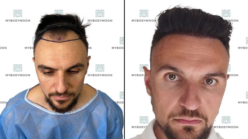 Greffe de cheveux avant-après : Découvrez les transformations de nos patients
