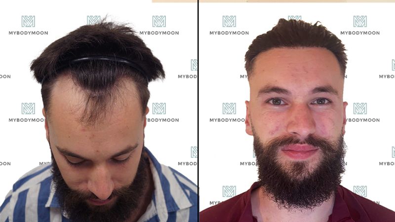 Greffe de cheveux avant-après : Découvrez les transformations de nos patients