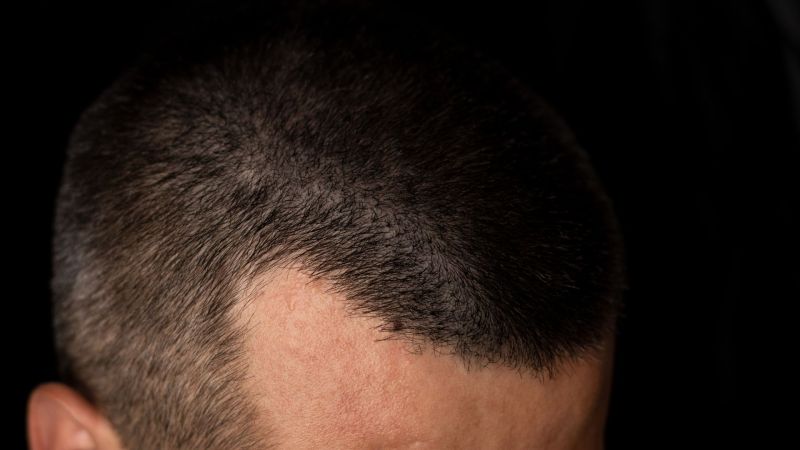 Est-il possible de perdre ses cheveux après une greffe capillaire ?