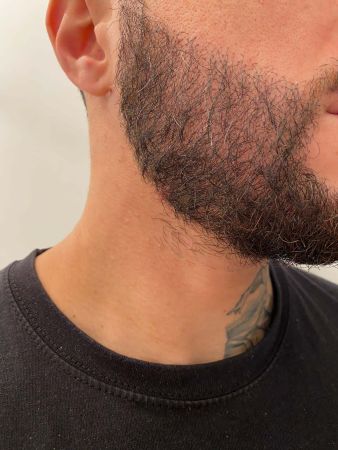 Greffe de barbe r%C3%A9sultat