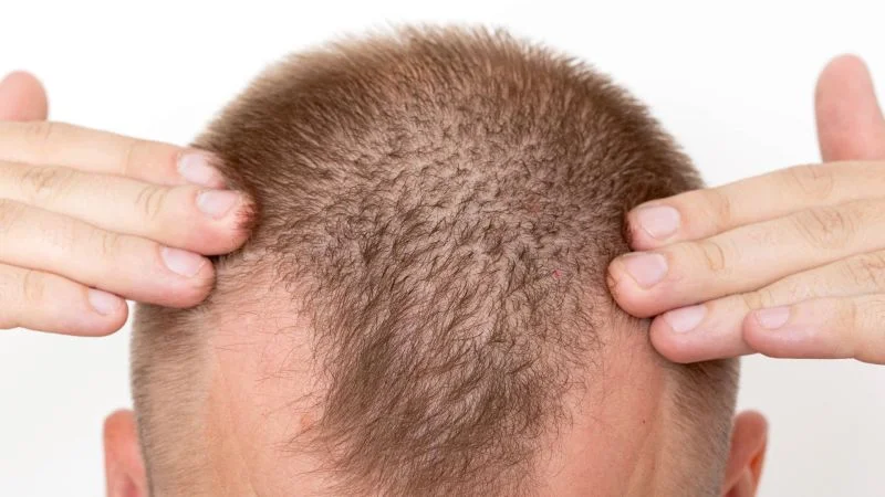 operation_greffe_cheveux_5000