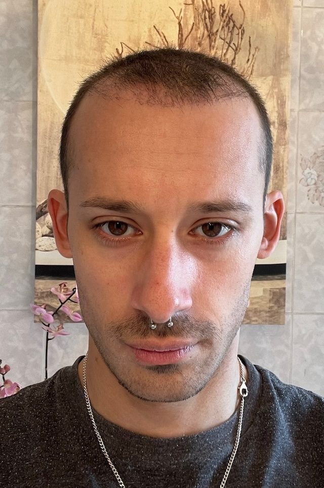 photo 10 jours post greffe capillaire photo 10 jours post greffe capillaire
