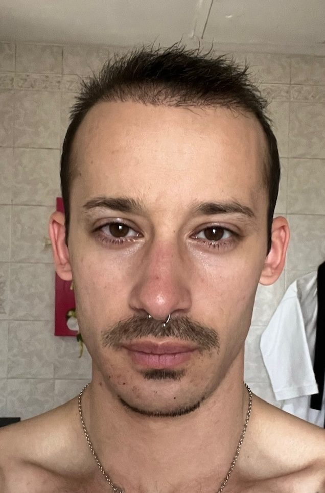 photo 3 mois post greffe capillaire photo 3 mois post greffe capillaire