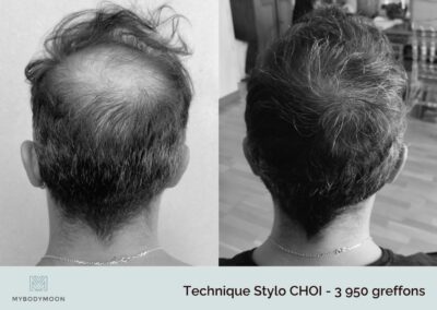 resultat avant apres stylo choi 3950 greffons