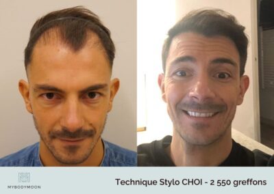 resultats avant apres greffe capillaire stylochoi 2550greffons