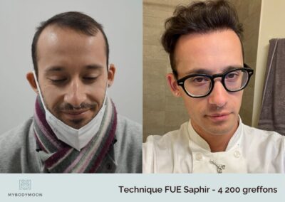 resultats avant apres greffe fue saphir 4200 greffons