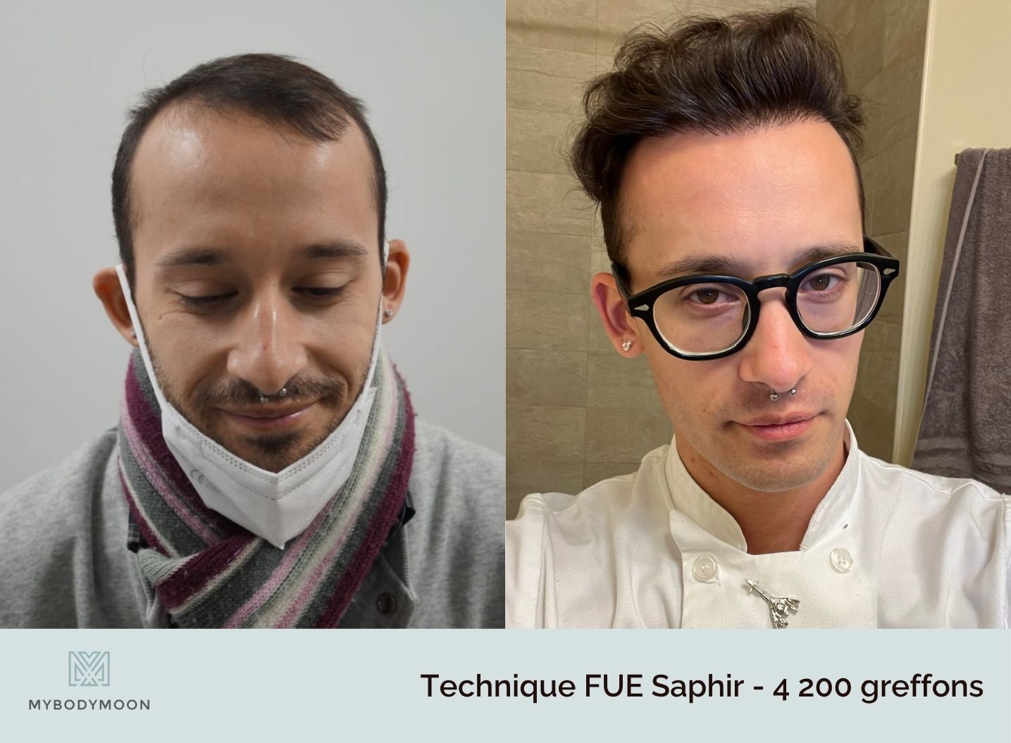 resultats avant apres greffe fue saphir 4200 greffons resultats avant apres greffe fue saphir 4200 greffons
