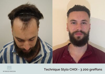 resultats avant apres greffe stylo choi 3200 greffons