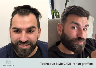 resultats avant apres greffe stylo choi 3500 greffons