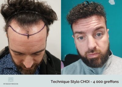 resultats avant apres greffe stylo choi 4000 greffons