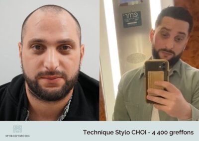 resultats avant apres greffe stylo choi 4400 greffons