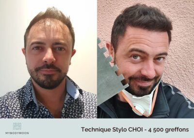 resultats avant apres greffe stylo choi 4500 greffons (2)