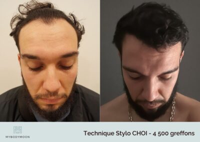 resultats avant apres greffe stylo choi 4500 greffons