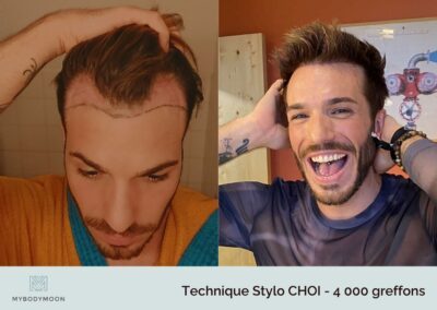 resultats greffe capillaire stylo choi 4000