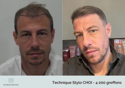 resultats greffe capillaire stylochoi 4200greffons