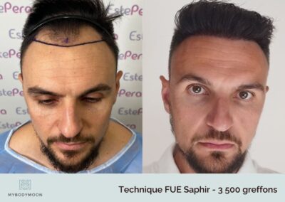 resultats greffe cheveux fue saphir 3500greffons