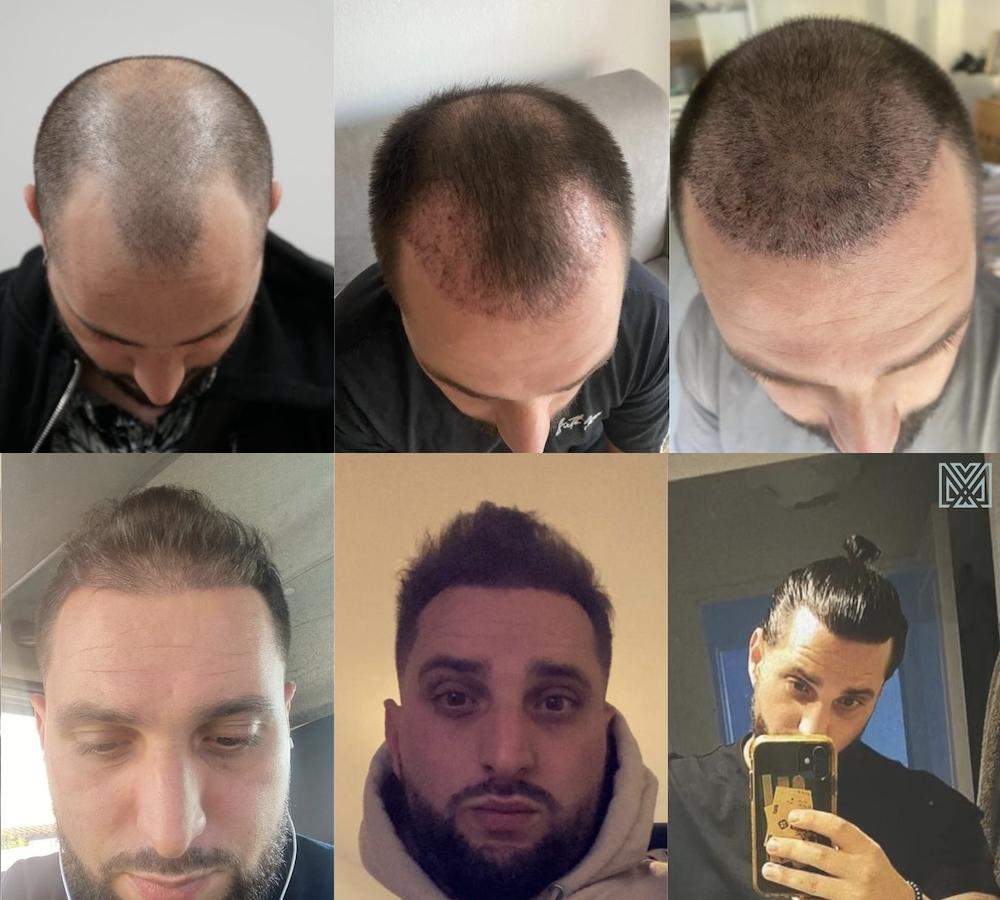 evolution greffe cheveux sur 1 an cyril 2 patients mybodymoon evolution greffe cheveux sur 1 an cyril