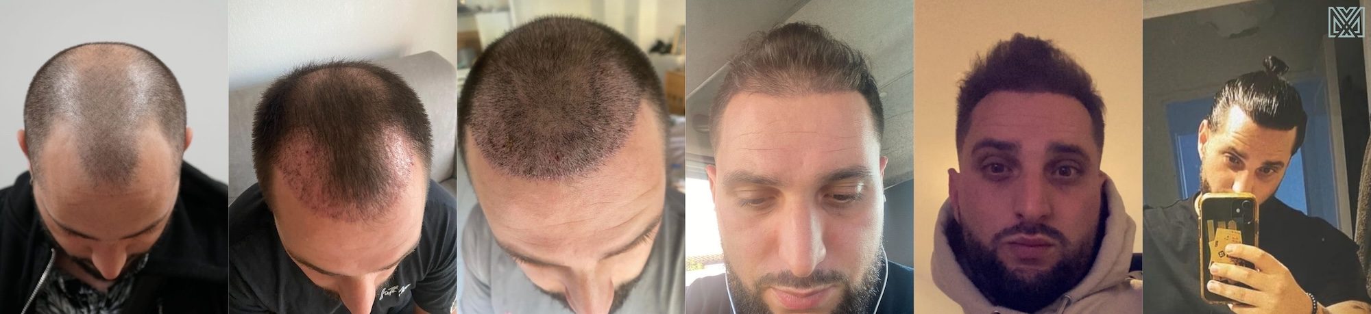 Evolution de la greffe de cheveux du patient Cyril résultats greffe capillaire sur 1 an