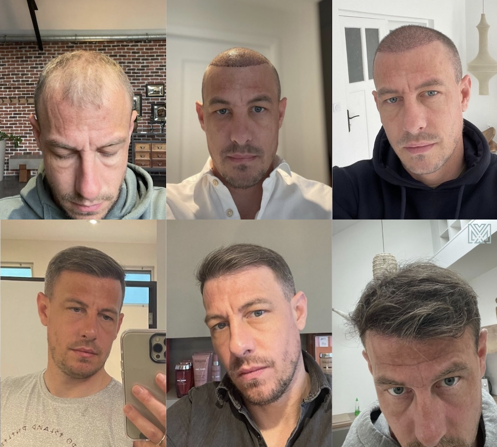 evolution greffe cheveux sur 1 an jeoffrey patients mybodymoon evolution greffe cheveux sur 1 an jeoffrey
