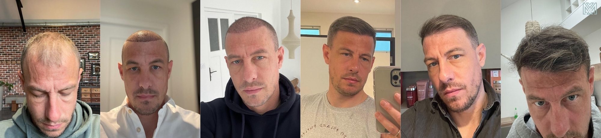 evolution de la greffe de cheveux du patient Jeoffrey evolution des résultats de la greffe de cheveux sur un an