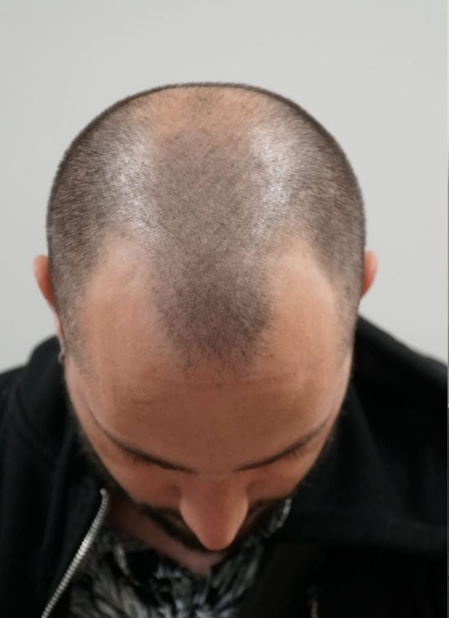 Cyril avant la greffe de cheveux cheveux en Turquie