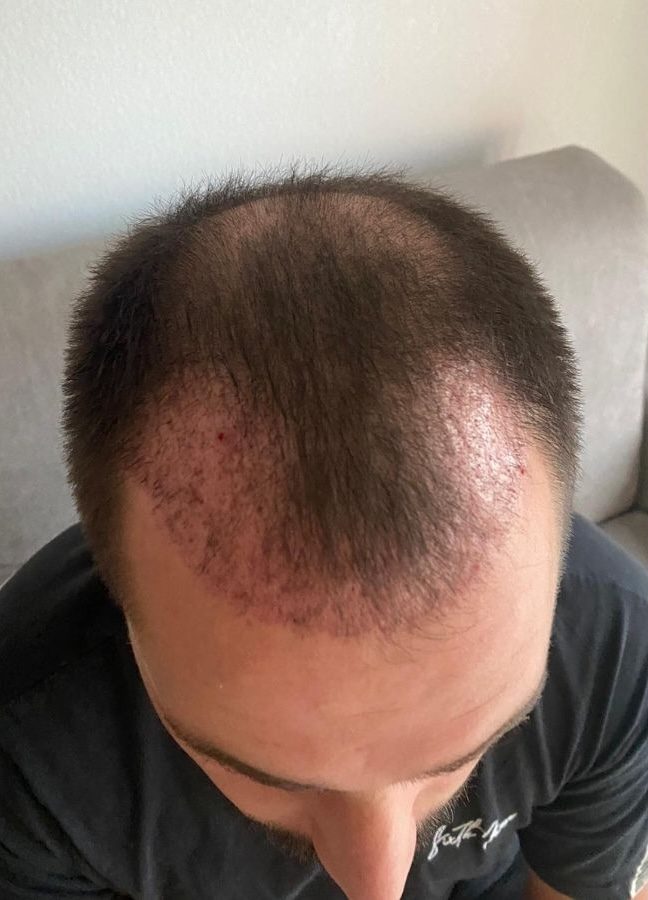 Résultats greffe de cheveux à 1 mois