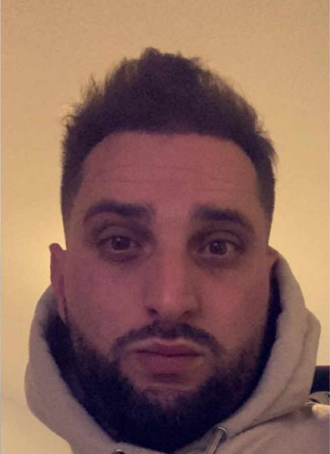 Résultats de greffe de cheveux à 6 mois de Cyril