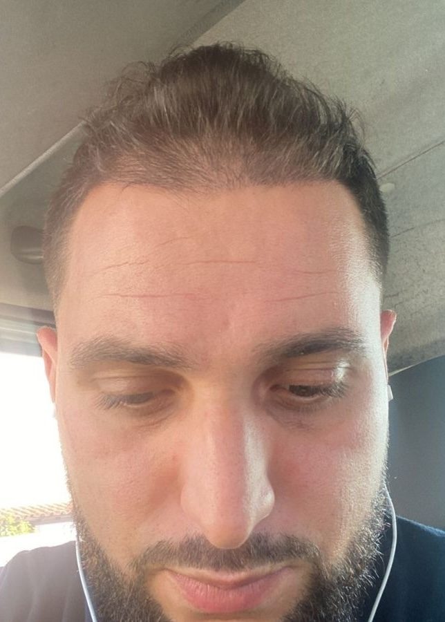 Résultats de greffe de cheveux à 3 mois