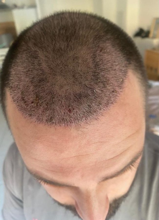 Evolution greffe de cheveux de Cyril