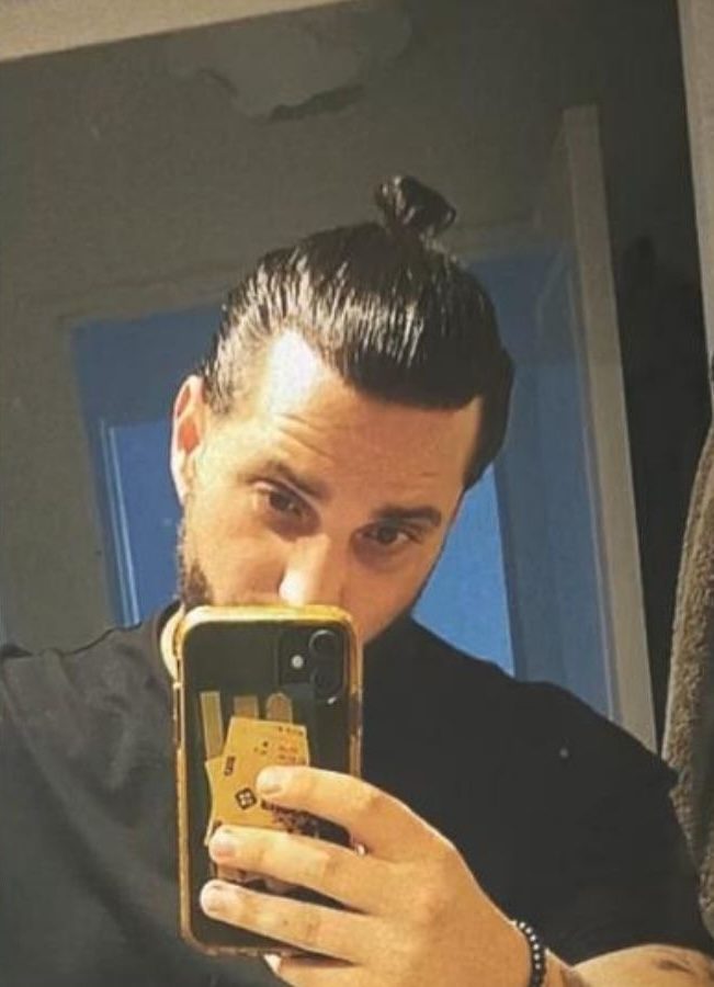 Résultats de greffe de cheveux de Cyril