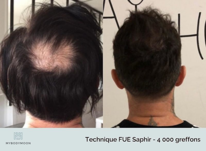 résultats zone donneuse après greffe de cheveux fue saphir pour une calvitie vertex