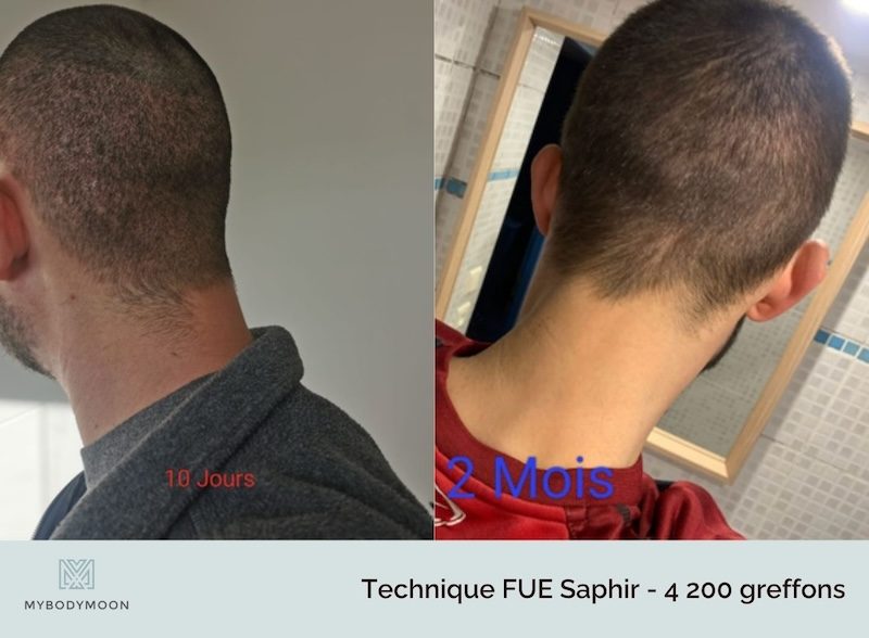 résultats zone donneuse après greffe de cheveux fue saphir 4 400 greffons à 10 jours et à 2 mois